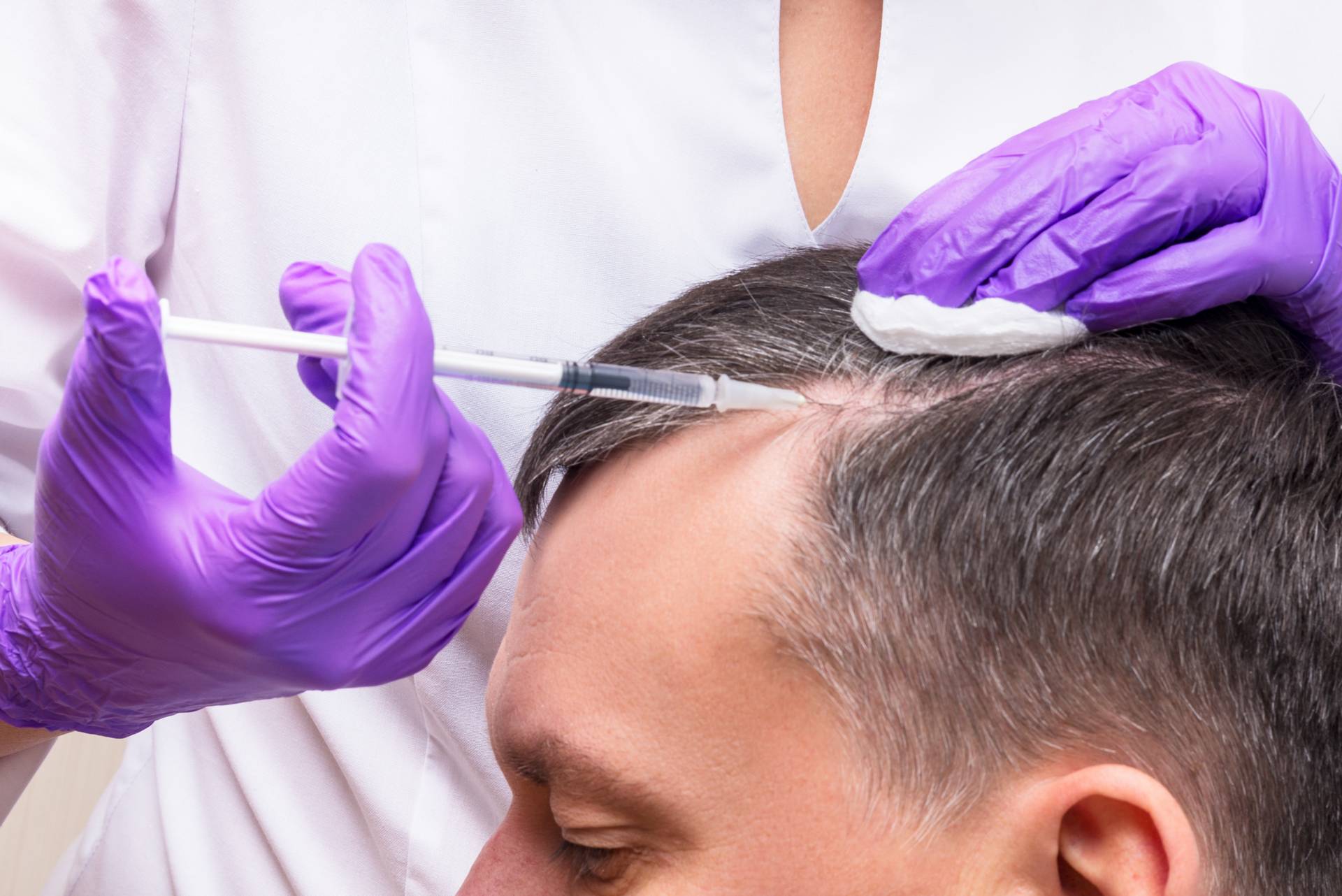 Alopecia Treatment Treatment in UAE