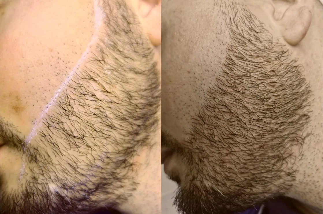 Beard & Mustache Micropigmentation Treatment