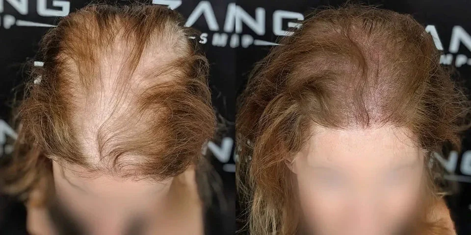 SMP For Women Treatment