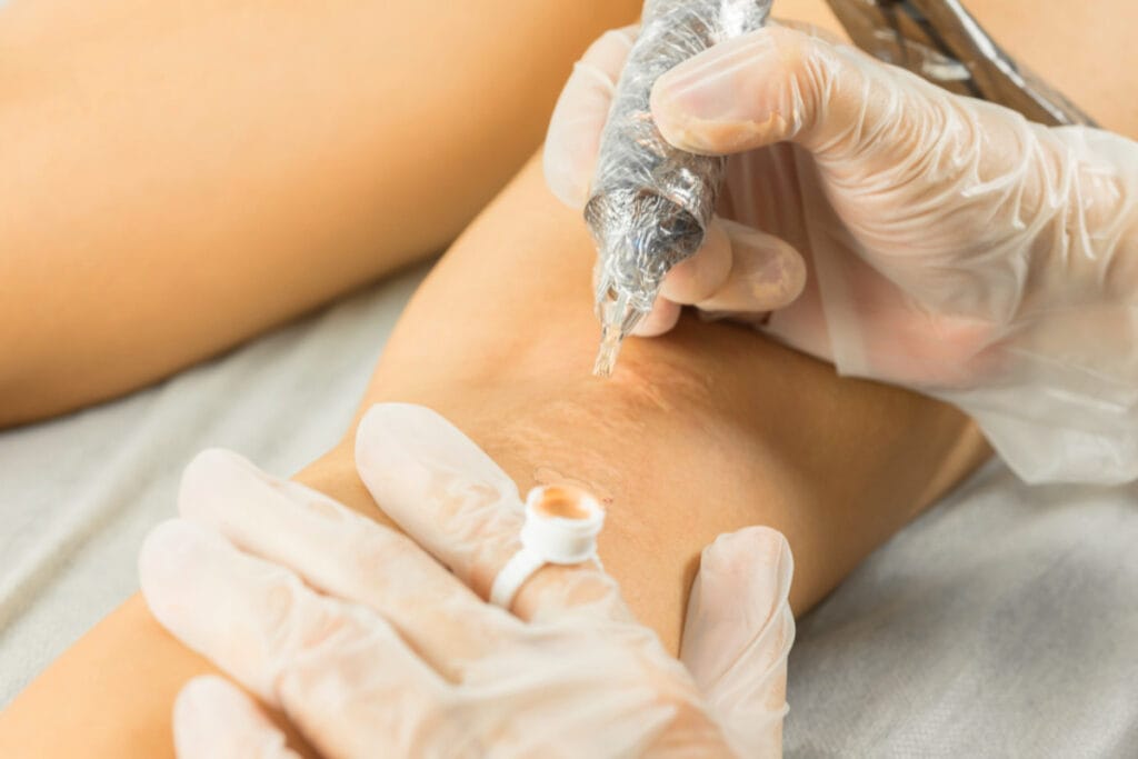 Scar Camouflage Treatment in UAE