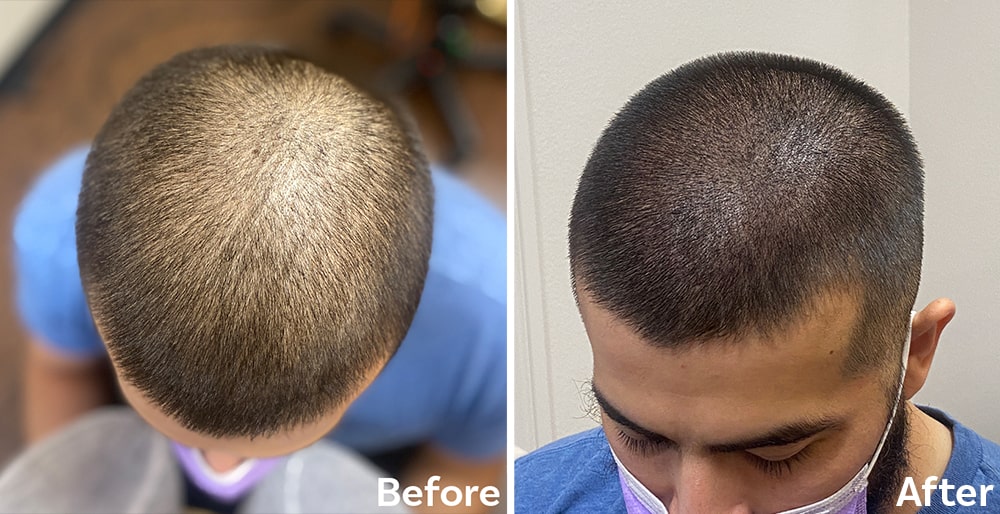 Scalp Micropigmentation
